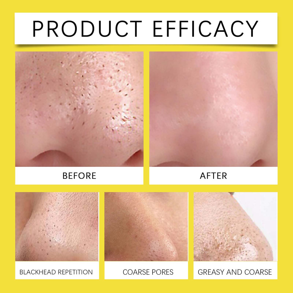 Hoygi Hydrocolloid Nose Patch, Hydrocolloid Invisible Concealer To Remove Blackheads And Acne Facial Pore Cleaning Nose Patch