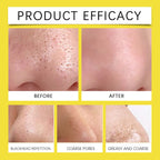 Hoygi Hydrocolloid Nose Patch, Hydrocolloid Invisible Concealer To Remove Blackheads And Acne Facial Pore Cleaning Nose Patch