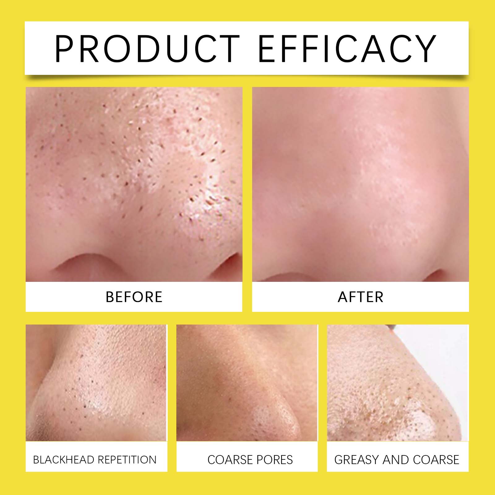 Hoygi Hydrocolloid Nose Patch, Hydrocolloid Invisible Concealer To Remove Blackheads And Acne Facial Pore Cleaning Nose Patch